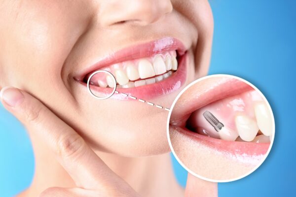 Dental Implants in Cudahy