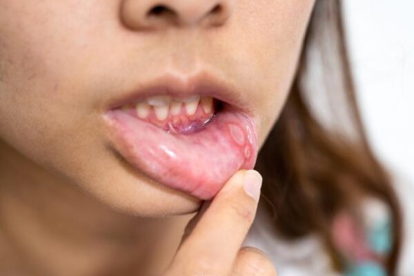 Get Rid of Lichen Planus Naturally