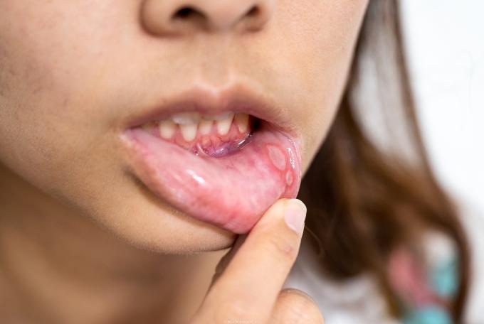 Get Rid of Lichen Planus Naturally