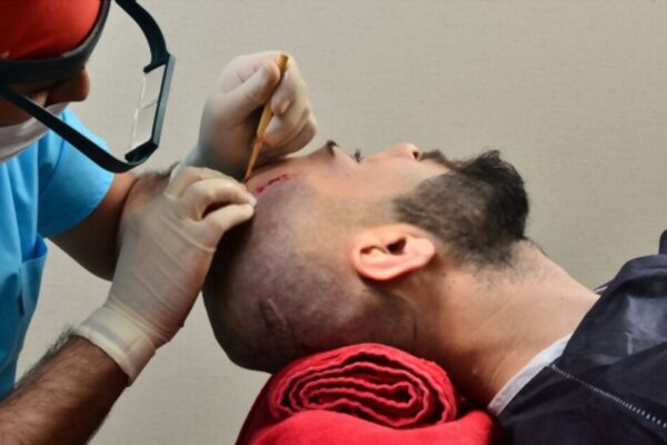 hair transplant clinic in pune