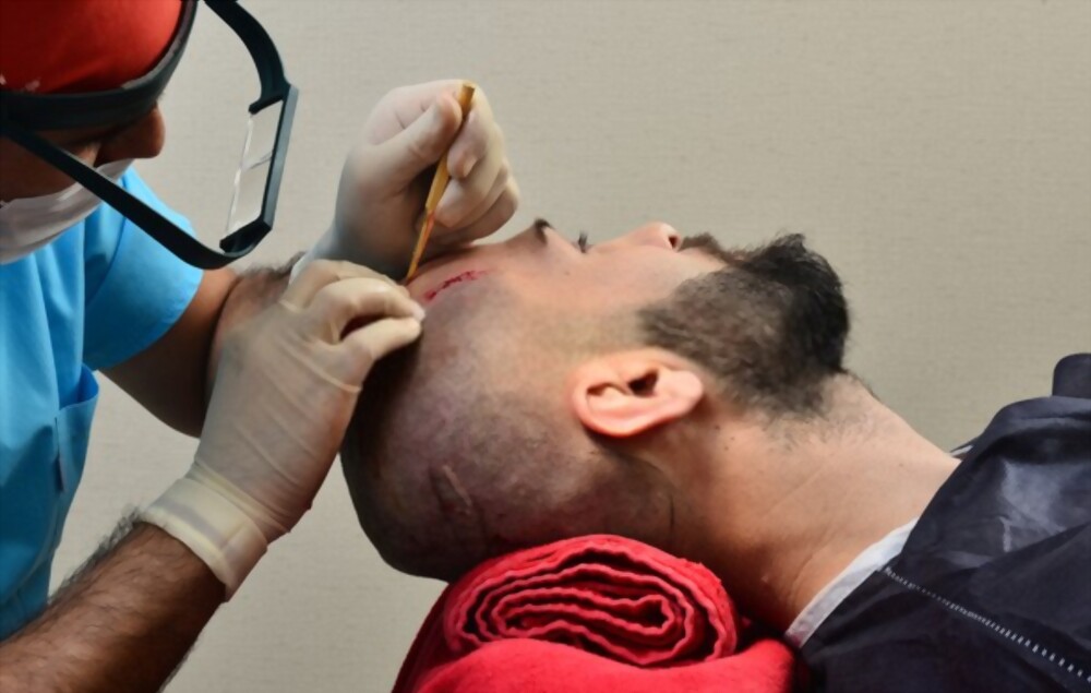 hair transplant clinic in pune