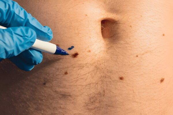 What Is the Safest Way to Get Rid of Skin Tags Fast?