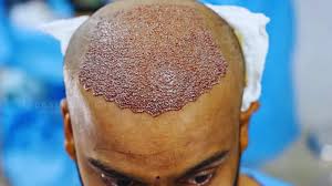 hair transplant Manchester