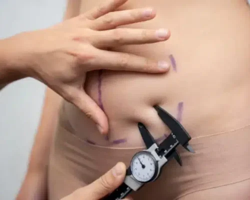 Remove Belly Fat in Pakistan
