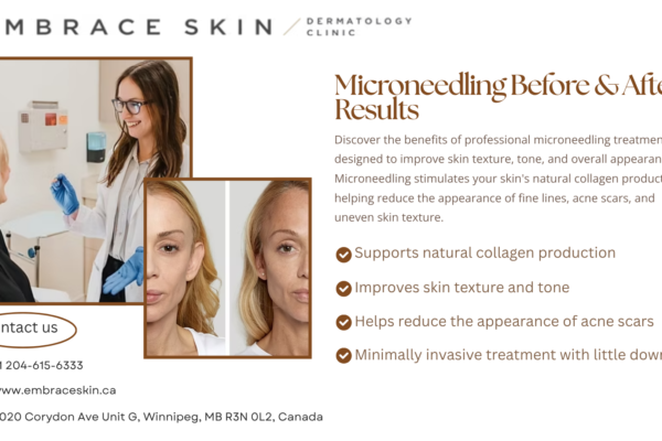 https://www.embraceskin.ca/micro-needling-and-prp-treatment-in-winnipeg