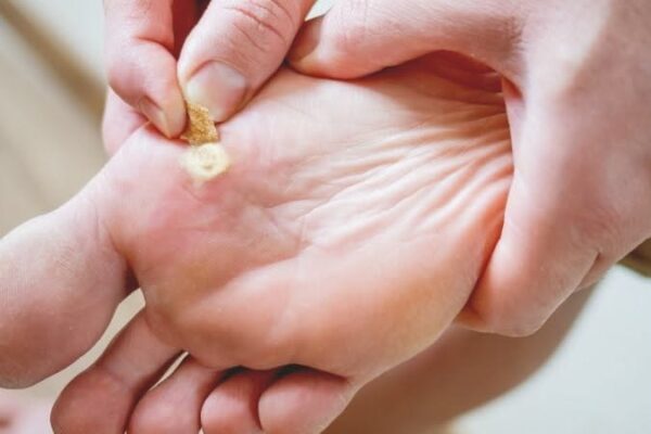 Home Remedies vs Professional Verruca Care in Edinburgh