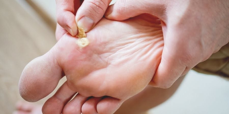 Home Remedies vs Professional Verruca Care in Edinburgh