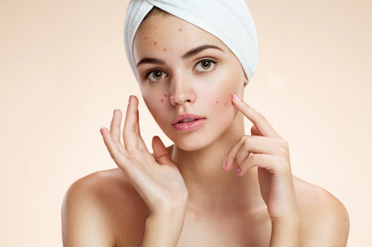 Acne Scar Treatment in Islamabad