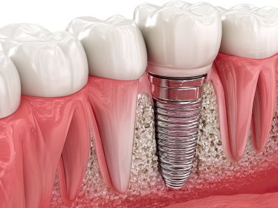 Dental Implants in Bandra - Dent Heal