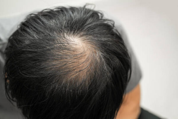 Exosomes therapy for hair loss in Riyadh