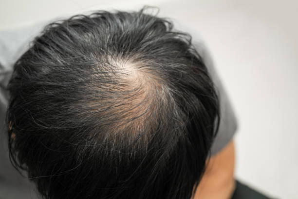 Exosomes therapy for hair loss in Riyadh