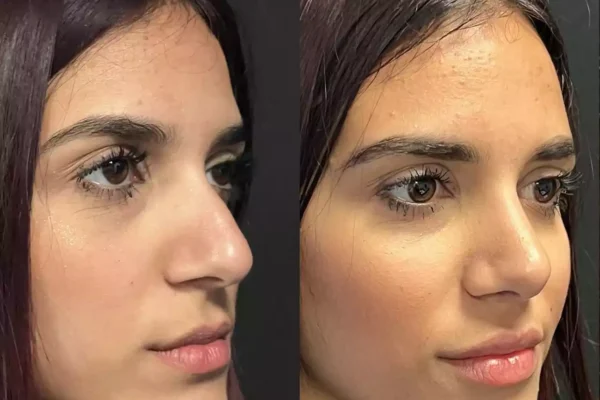 Septoplasty in Dubai