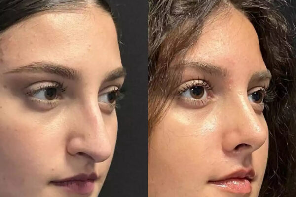 Rhinoplasty in Dubai