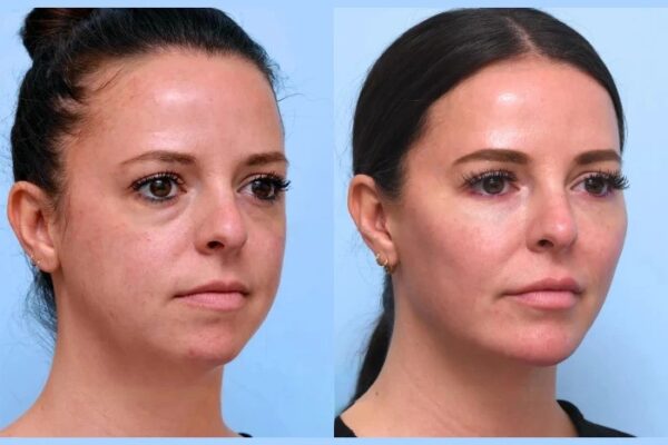 Best Plastic Surgeon in Dubai: Safe Thread Lift Treatments with Natural Results