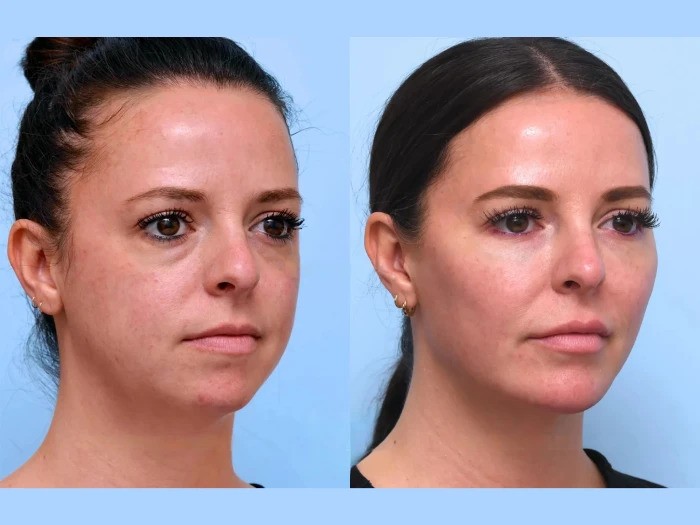 Best Plastic Surgeon in Dubai: Safe Thread Lift Treatments with Natural Results