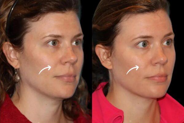 sculptra fillers in dubai