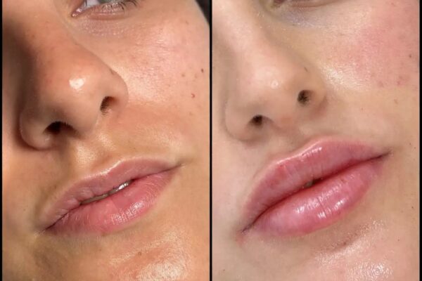 dermal fillers