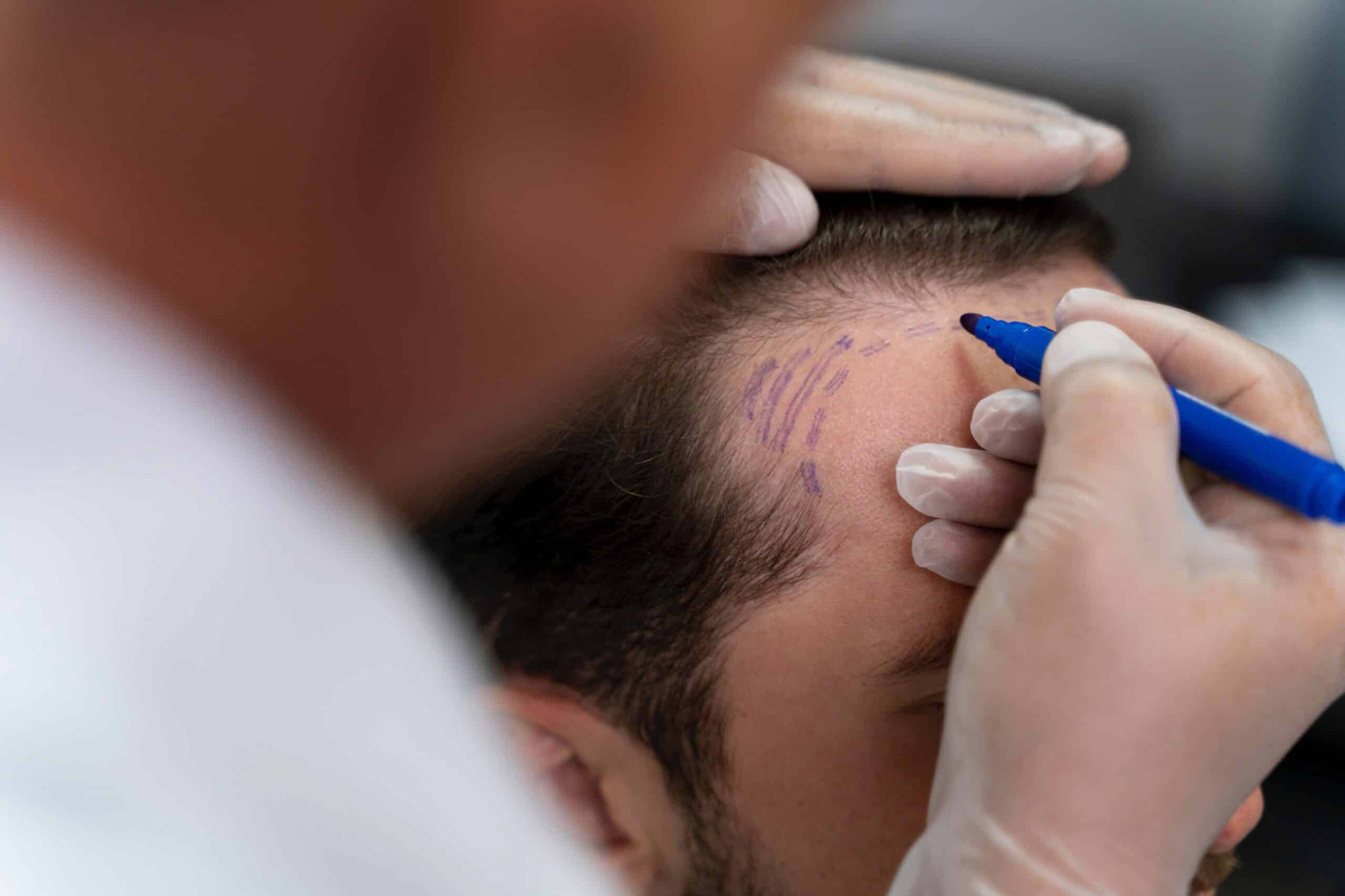 Hair Transplant in Islamabad