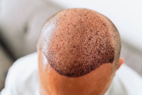 hair transplant in pune