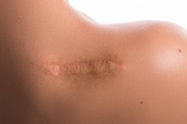 Keloid Treatment in Riyadh