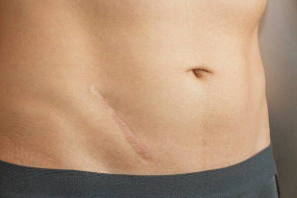 Laser Scar Removal in Riyadh