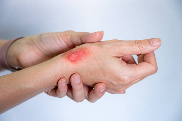 Lipoma Treatment in Riyadh