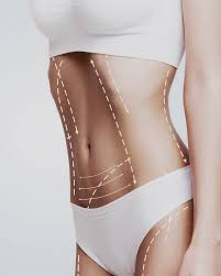 Liposuction Surgery in Islamabad