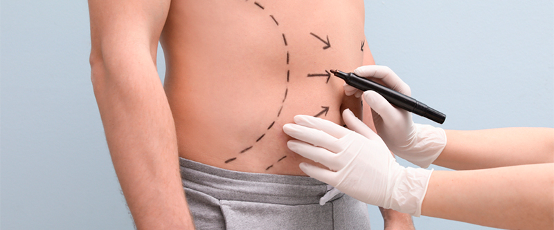 Liposuction in Islamabad