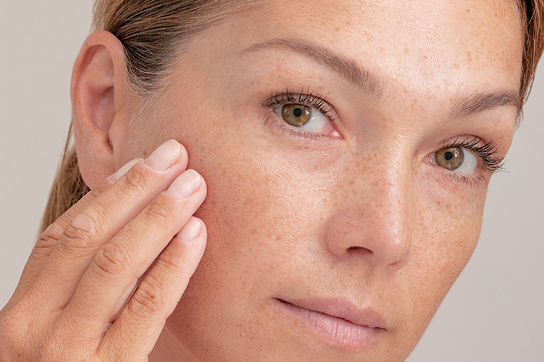 Melasma Treatment in Islamabad