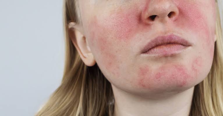 Rosacea Treatment In Islamabad
