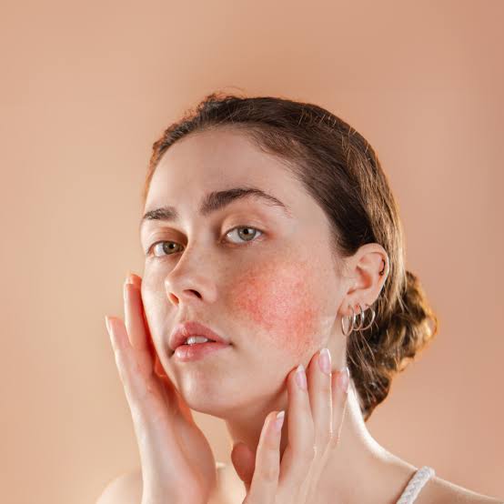 Rosacea Treatment In Islamabad