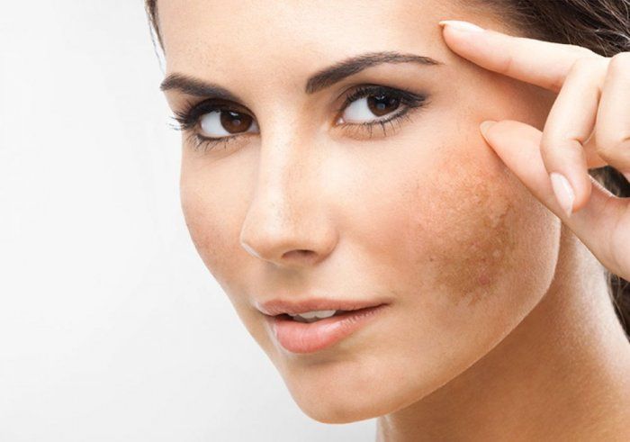 Skin Pigmentation Treatment in Islamabad