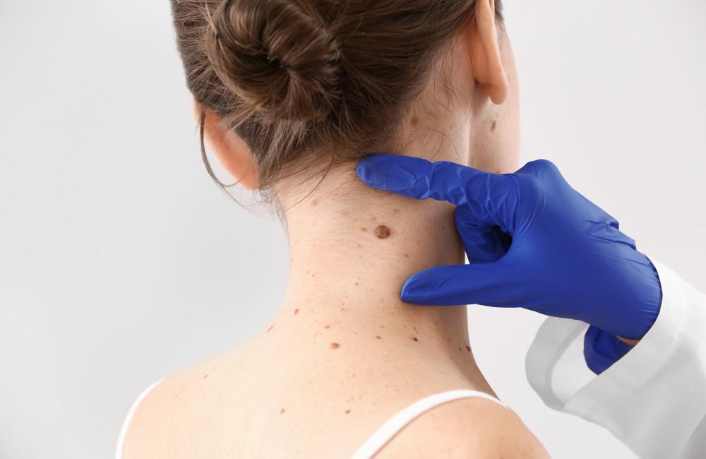 Skin Tag Removal in Islamabad