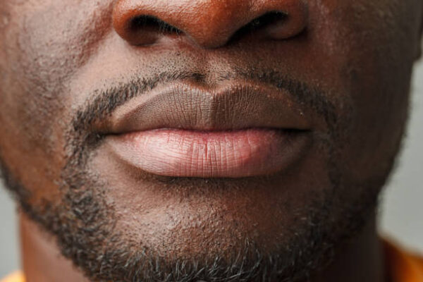 Smoker’s Lips Treatment in Riyadh