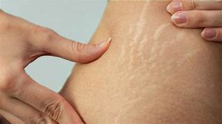 Stretch marks removal treatment