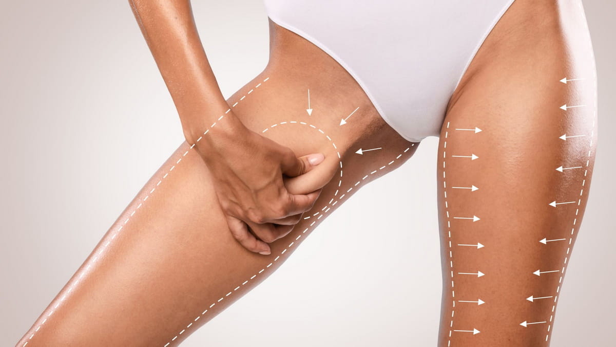 Thigh Liposuction in Islamabad
