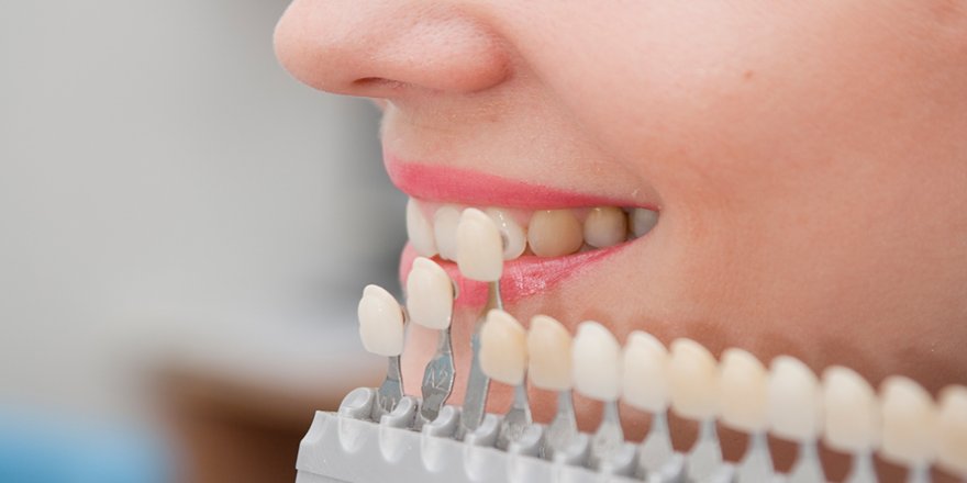 Veneers In Islamabad