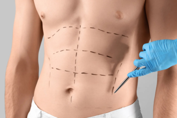 abdominoplasty in Islamabad