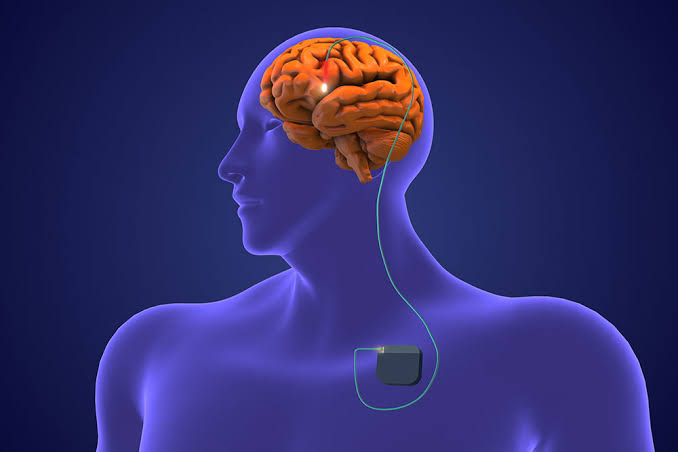 Deep Brain Stimulation