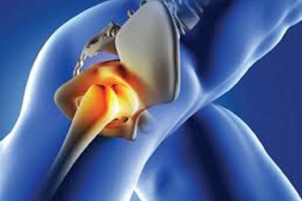 hip replacement surgeon