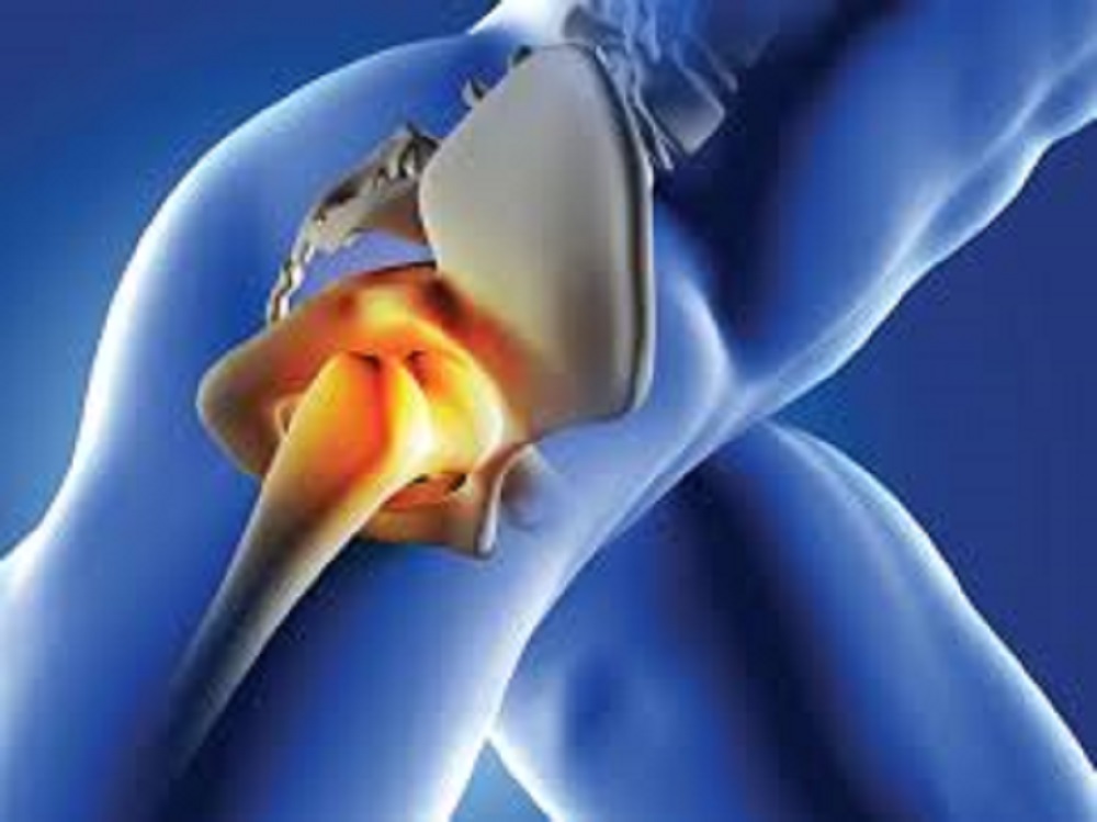 hip replacement surgeon