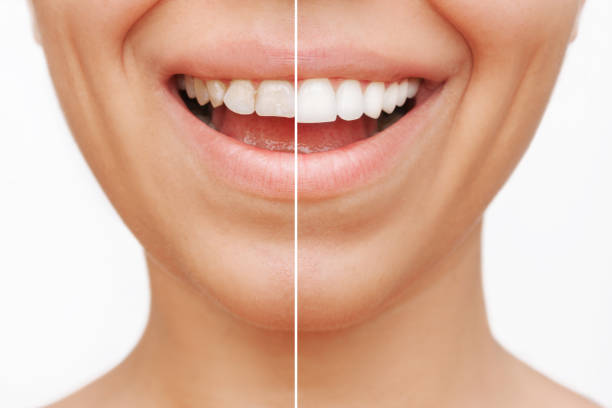 How Veneers Help Create a More Balanced and Attractive Smile Dental Veneers in Pakistan: