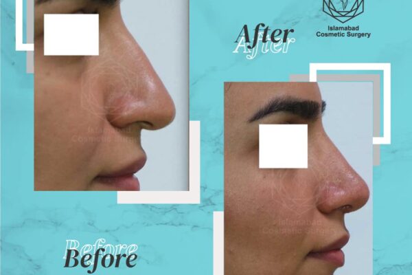 rhinoplasty islamabad