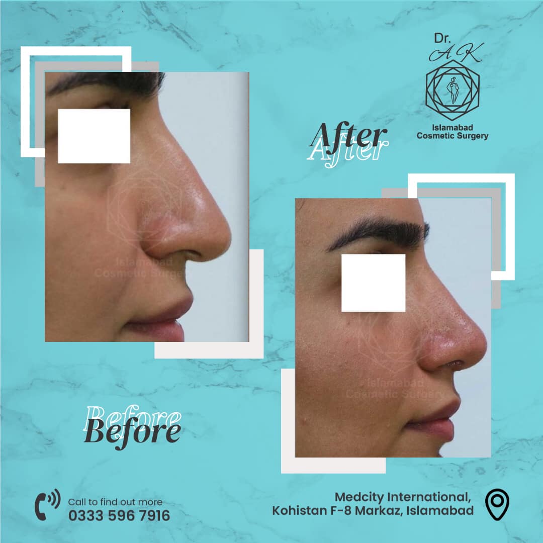 rhinoplasty islamabad