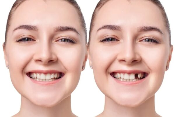 implants