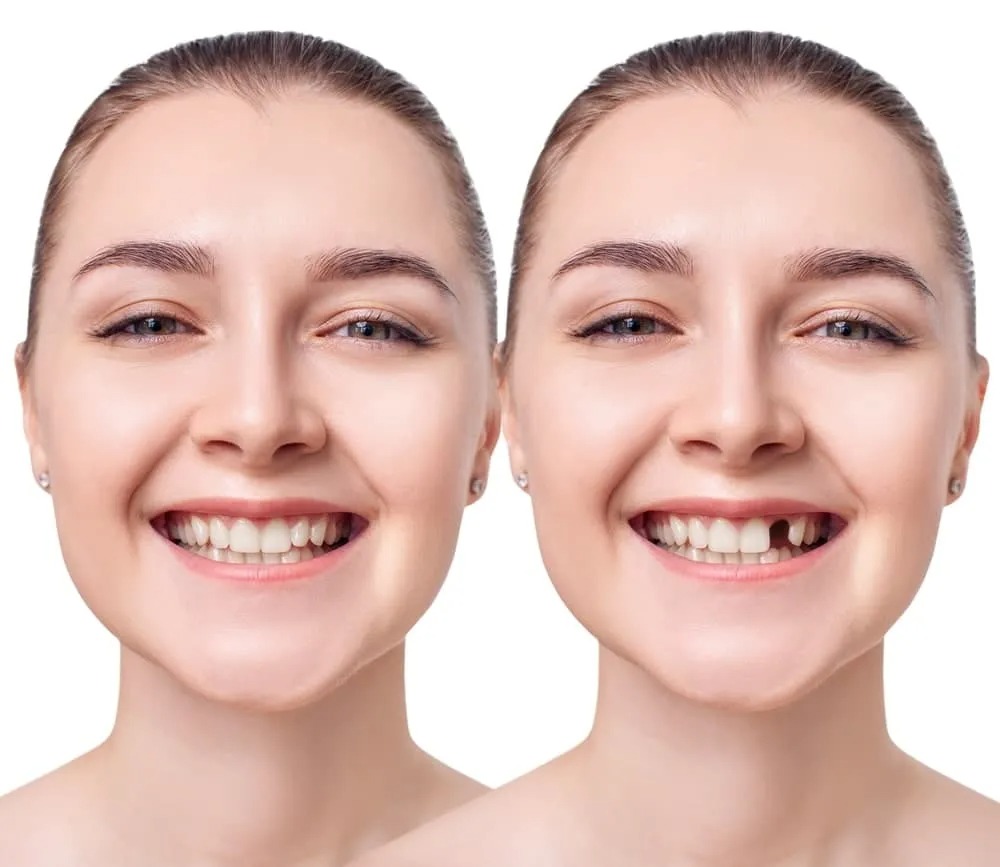 implants