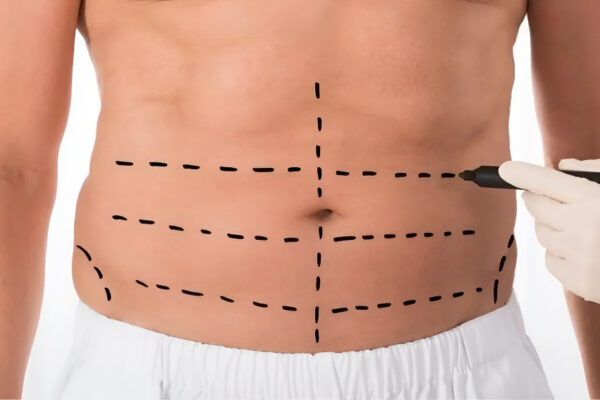 tummy tuck surgery in Islamabad
