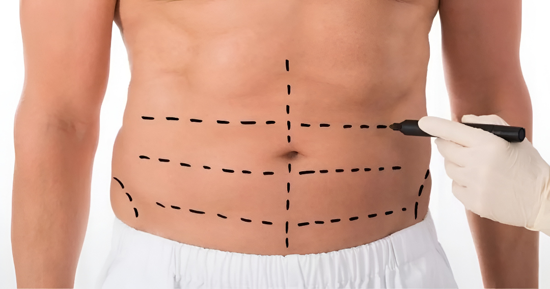 tummy tuck surgery in Islamabad