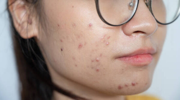 Acne Scar Treatment in Riyadh