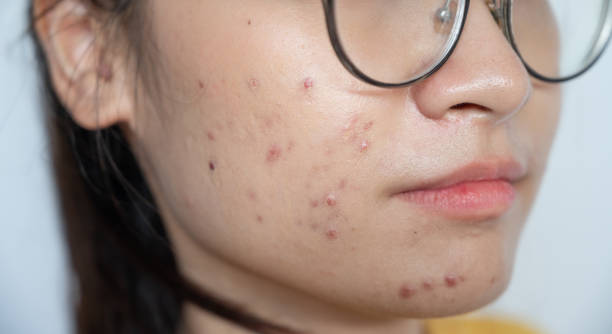 Acne Scar Treatment in Riyadh